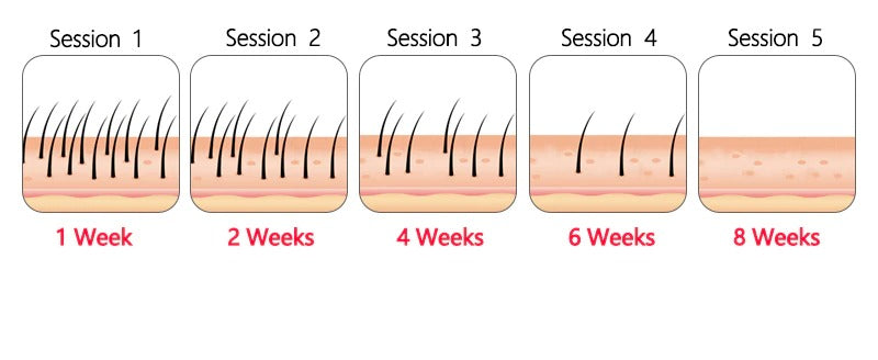 At Home Laser Hair Removal Permanent Hair Removal Device