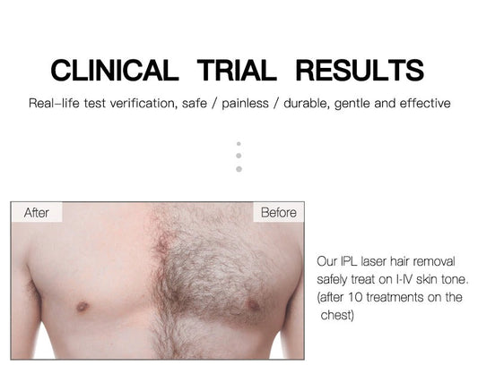 At Home Laser Hair Removal Permanent Hair Removal Device