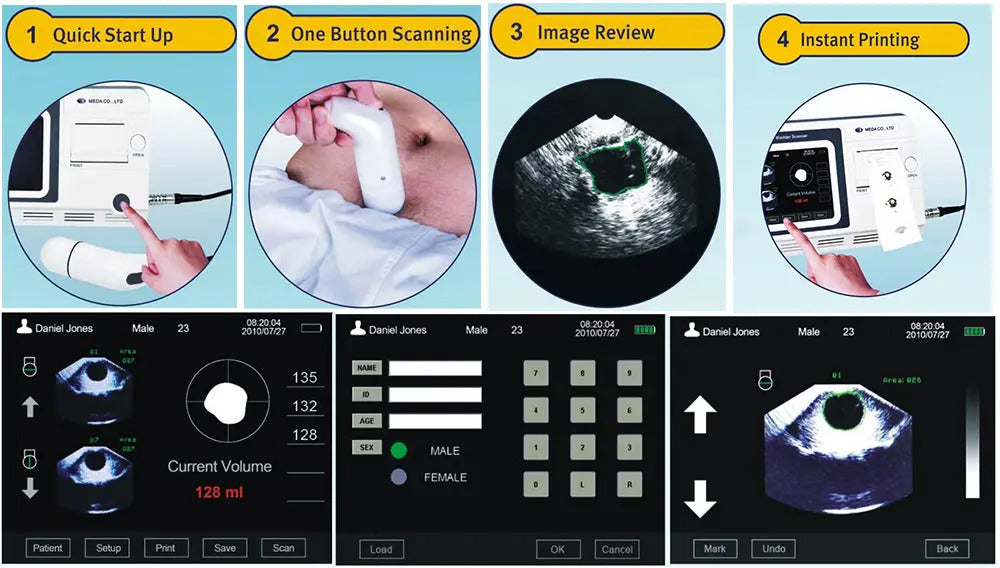 Bladder Volume Tester I Bladder Scan I MD-6000 - bladder